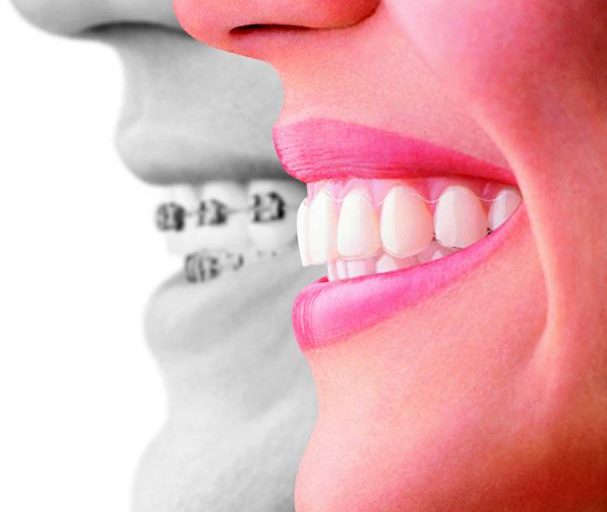 Invisalign and Invisalign Teen Special Grand Opening Offer