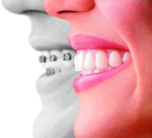 Invisalign and Invisalign Teen Special Grand Opening Offer