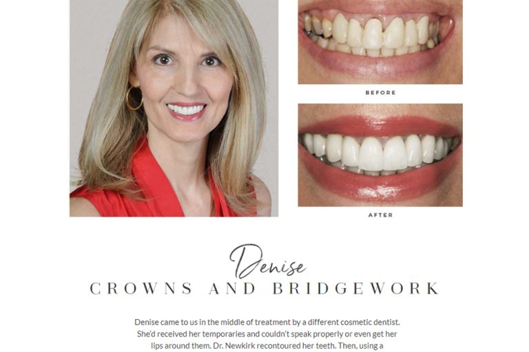 Building an effective smile gallery