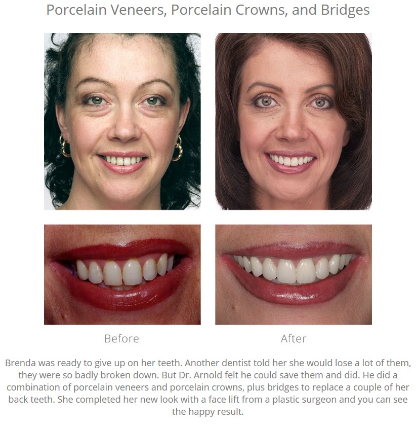 Before-and-after photographs of a woman who had a smile makeover, with a caption: "Brenda was ready to give up on her teeth. Another dentist told her she would lose a lot of them, they were so badly broken down. But Dr. Arnold felt he could save them and did. He did a combination of porcelain veneers and porcelain crowns, plus bridges to replace a couple of her back teeth. She completed her new look with a face lift from a plastic surgeon and you can see the happy result."